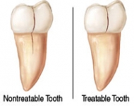 Family Dentist East Point GA 30344 | Cracked Teeth