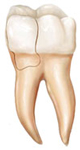 Family Dentist East Point GA 30344 | Fractured Cusp